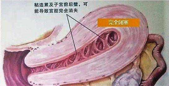 高安有香港验血测男女机构吗,宫腔粘连难好孕，收好这些备孕知识吧！